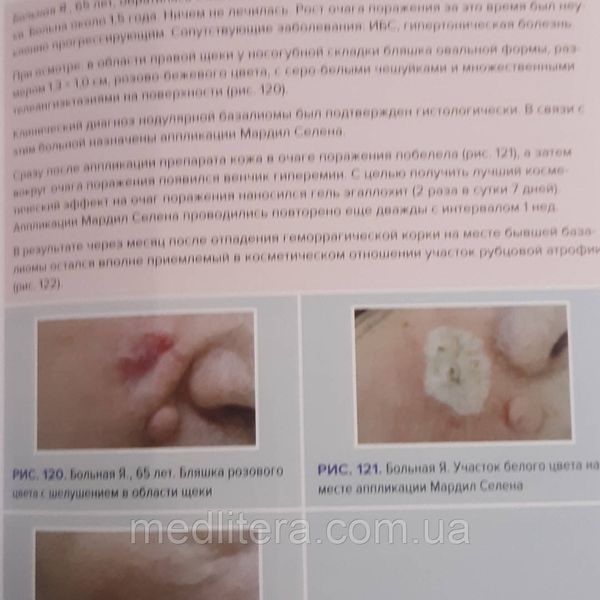 Молочков В.А., Молочкова Ю.В. Дерматоонкология. Лечение 22665е фото