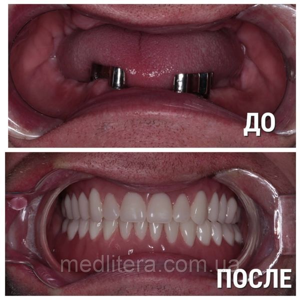 Стандарт полного съемного зубного протеза Накагоми Тасио 1666178529 фото