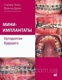 Міні-імплантати. Ортодонтія майбутнього. Іскандер Эллуз, Франсуа Дарці. 2021 р. 12877 фото
